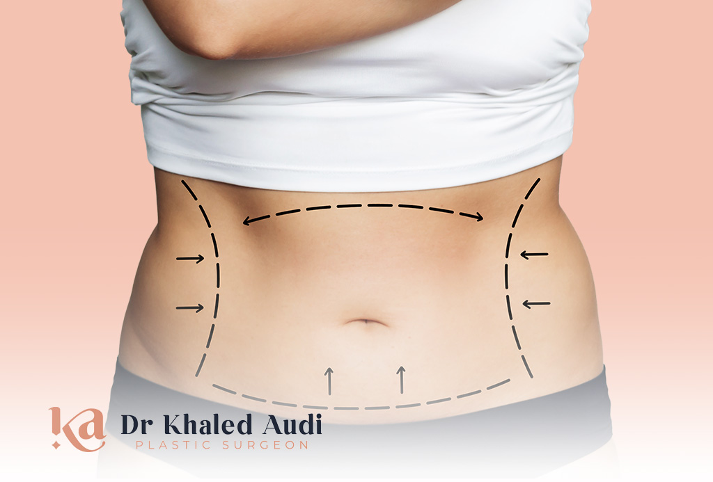 -ش- البطن-Tummy-Tuck